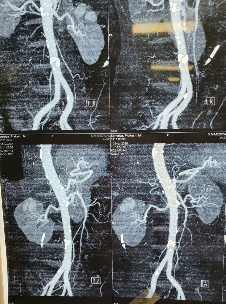 Abdomen Pain Caused due to Renal Mass Treated by Partial Nephrectomy | Dr. Bhoopat Bhati|Urozoone Holistic Kidney Care Clinic|Viman Nagar,Pune