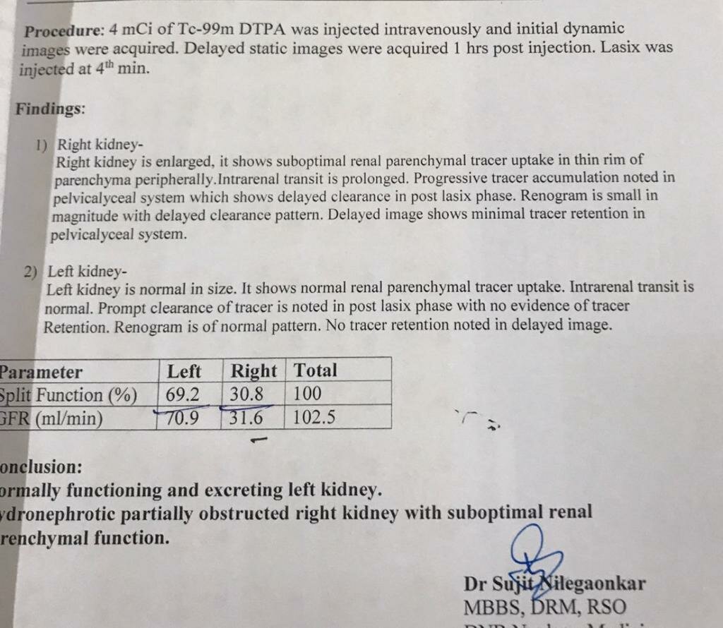 Abdomen Pain Caused by PUJ Obstruction Treated by 3D Laproscopic Pyeloplasty | Dr. Boopat Bhati|Urozoone Holistic Kidney Care Clinic|Viman Nagar,Pune