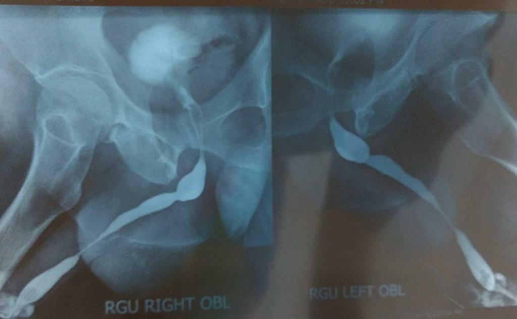 Difficulty in Urinating Treatment by Buccal Mucosa Graft Urethroplasty | Dr. Bhoopat Bhati|Urozoone Holistic Kidney Care Clinic|Viman Nagar,Pune