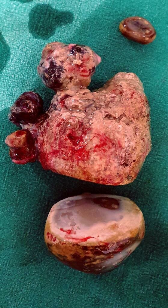 Large Kidney Stone Removed by Surgery in Pune | Dr. Bhoopat Bhati|Urozoone Holistic Kidney Care Clinic|Viman Nagar,Pune