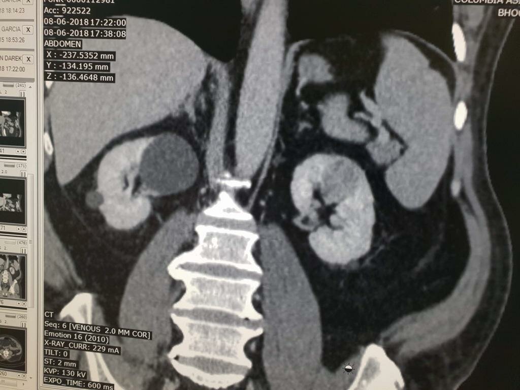 Abdomen Pain Caused by Left Renal mass Treated with Open Partial Nephron Sparing | Dr. Bhoopat Bhati|Urozoone Holistic Kidney Care Clinic|Viman Nagar,Pune